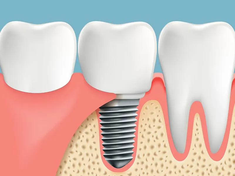 Dental implants