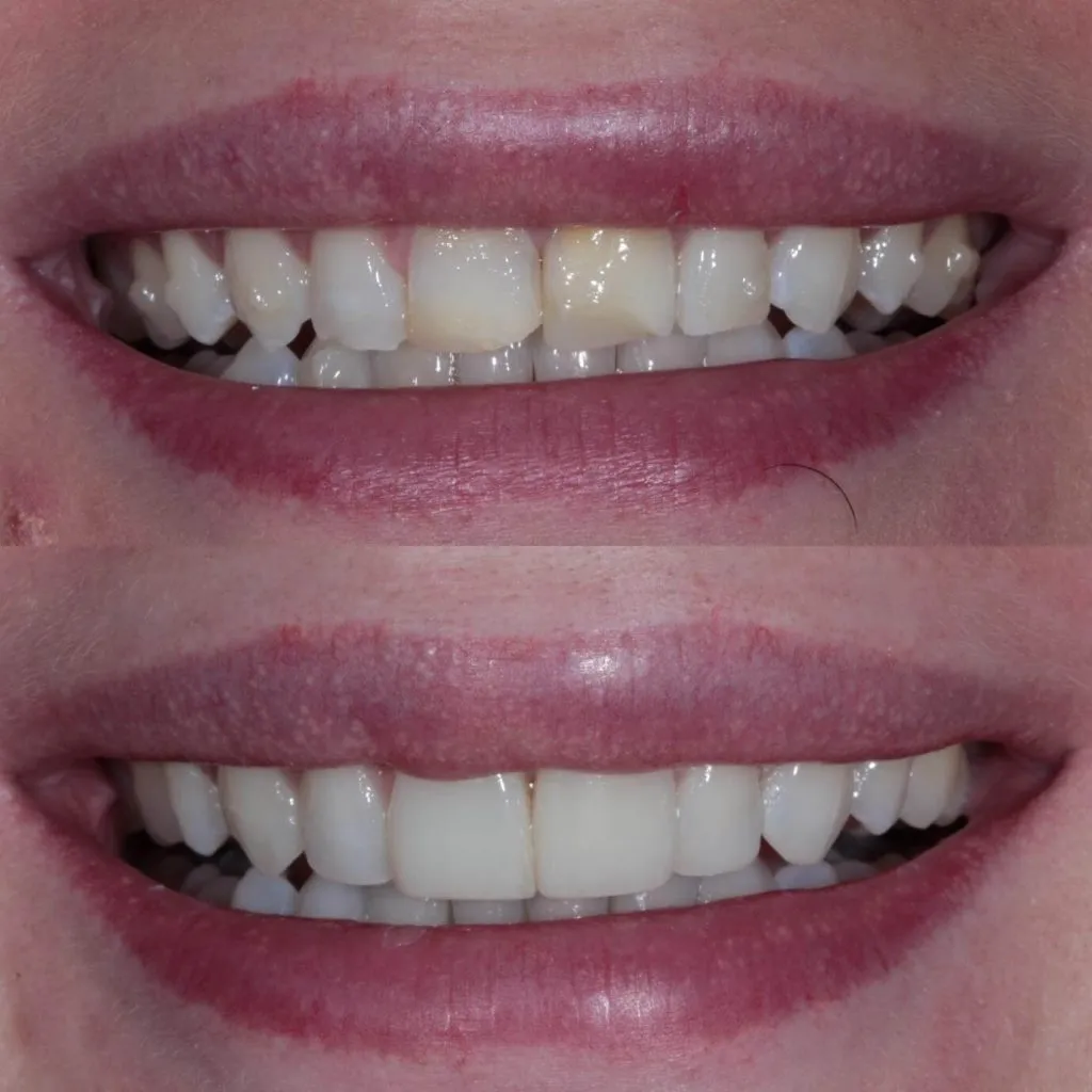 Invisalign Case Invisalign Case