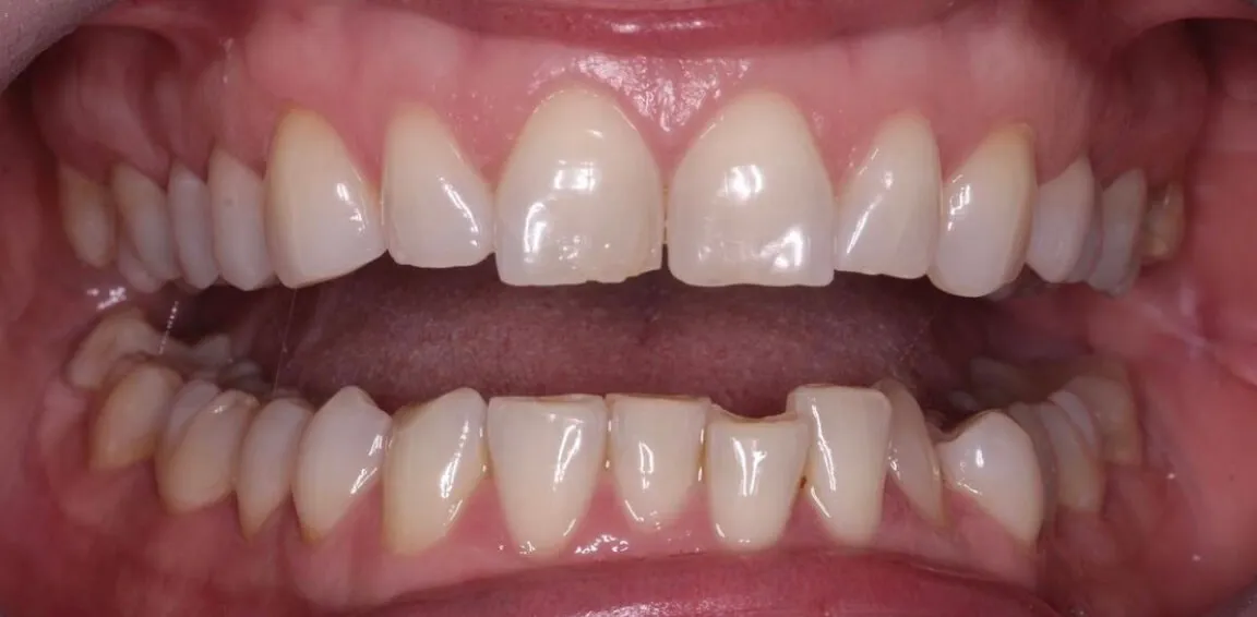 Invisalign - Before