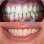 A fantastic transformation for a lovely patient using @invisalign clear aligners and some edge bonding to create a beautiful, straight, even smile 😁🦷👌 

Interested in having treatment like this? Get in touch with our expert team @hunterstreetdental @dralastairfraser 🖥️ 📱 #invisalign #invisalignbeforeandafter #digitaldentistry #advanceddentalcare #bestteam #happypatient