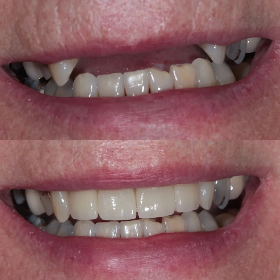 Dental Implant