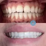 Invisalign, whitening and composite bonding to brighten and enhance this smile. A great result for a lovely, compliant patient 🦷😁🤙 #greygables_dental #invisalign #invisalignbeforeandafter #toothwhitening #bestteam #digitaldentistry #advanceddentalcare #hunterstreetdental