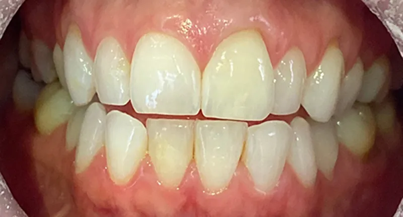 Invisalign Before