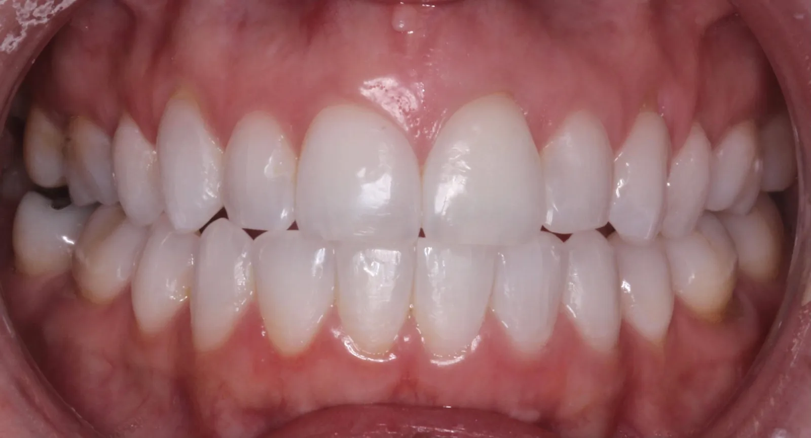 Invisalign - After 1