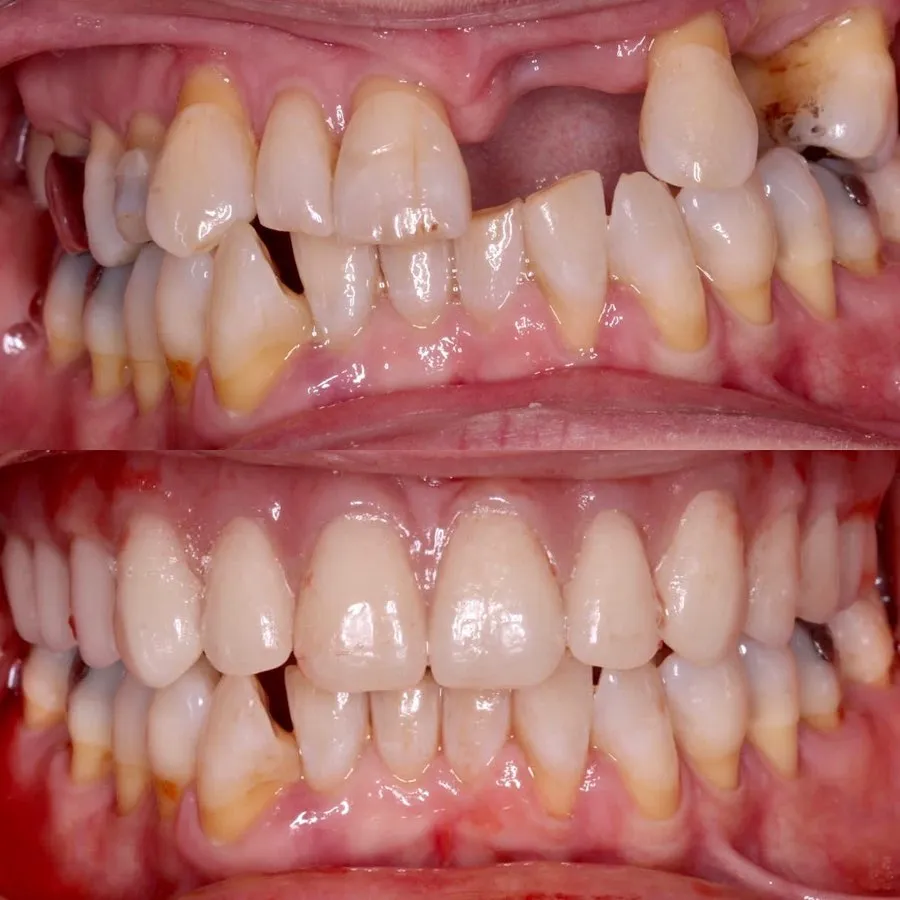 Missing Teeth