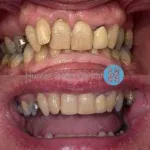 Another fantastic transformation using @invisalign clear aligners 😁🙌👌 If you’re interested in having treatment like this, get in touch with our wonderful team 📱🖥️ #invisalign #clearaligners #hunterstreetdental #beforeandafter #digitaldentistry #advanceddentalcare #bestteam