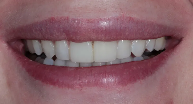 Invisalign Case 1 After