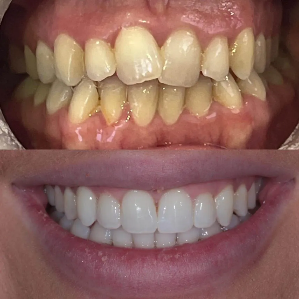 Invisalign Case 2 Invisalign Case