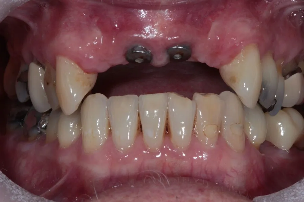 Dental Implant