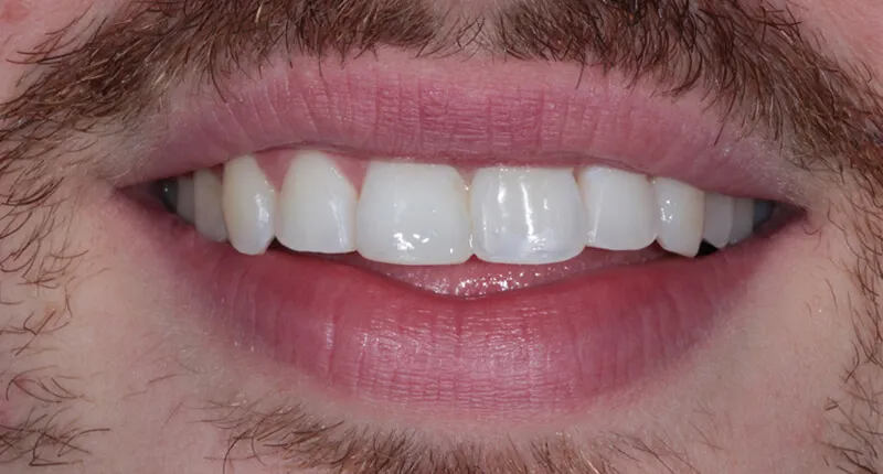 Invisalign Case 2 After