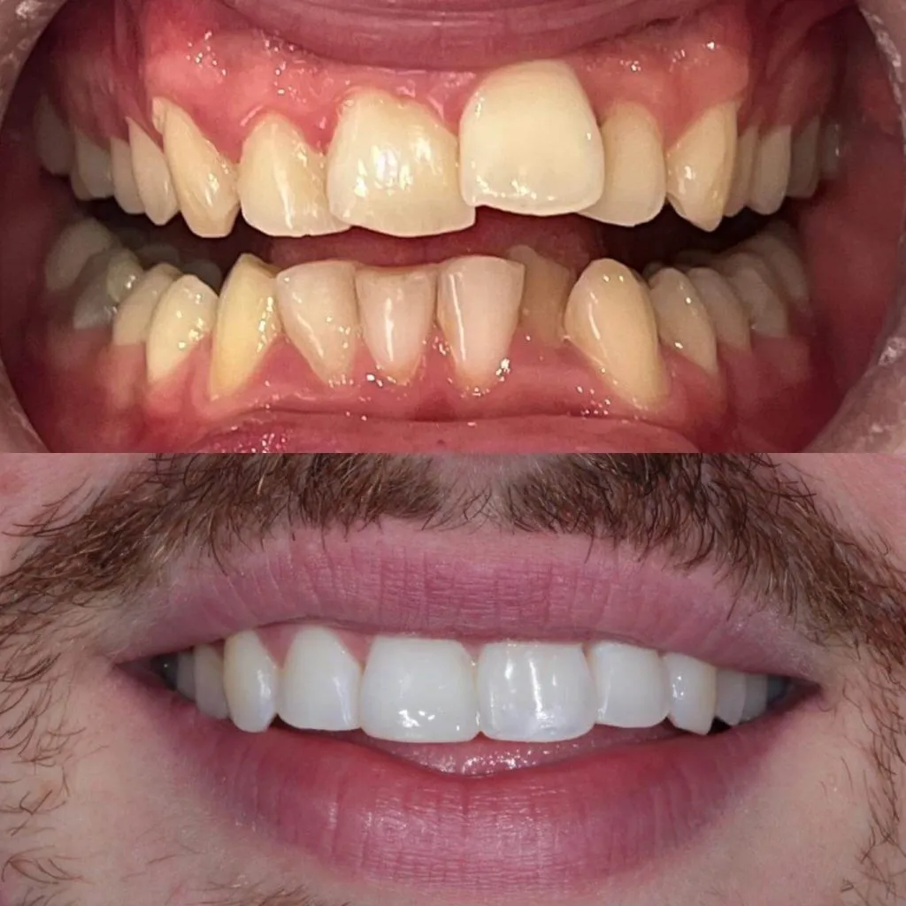 Invisalign Case 3