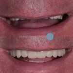 Digital dentures at @hunterstreetdental to improve this patients tooth show and transform their smile 😁 Interested in treatment like this? Get in touch with our expert team 🦷👌📱 #hunterstreetdental #digitaldentisty #digitaldentures #advanceddentalcare #bestteam