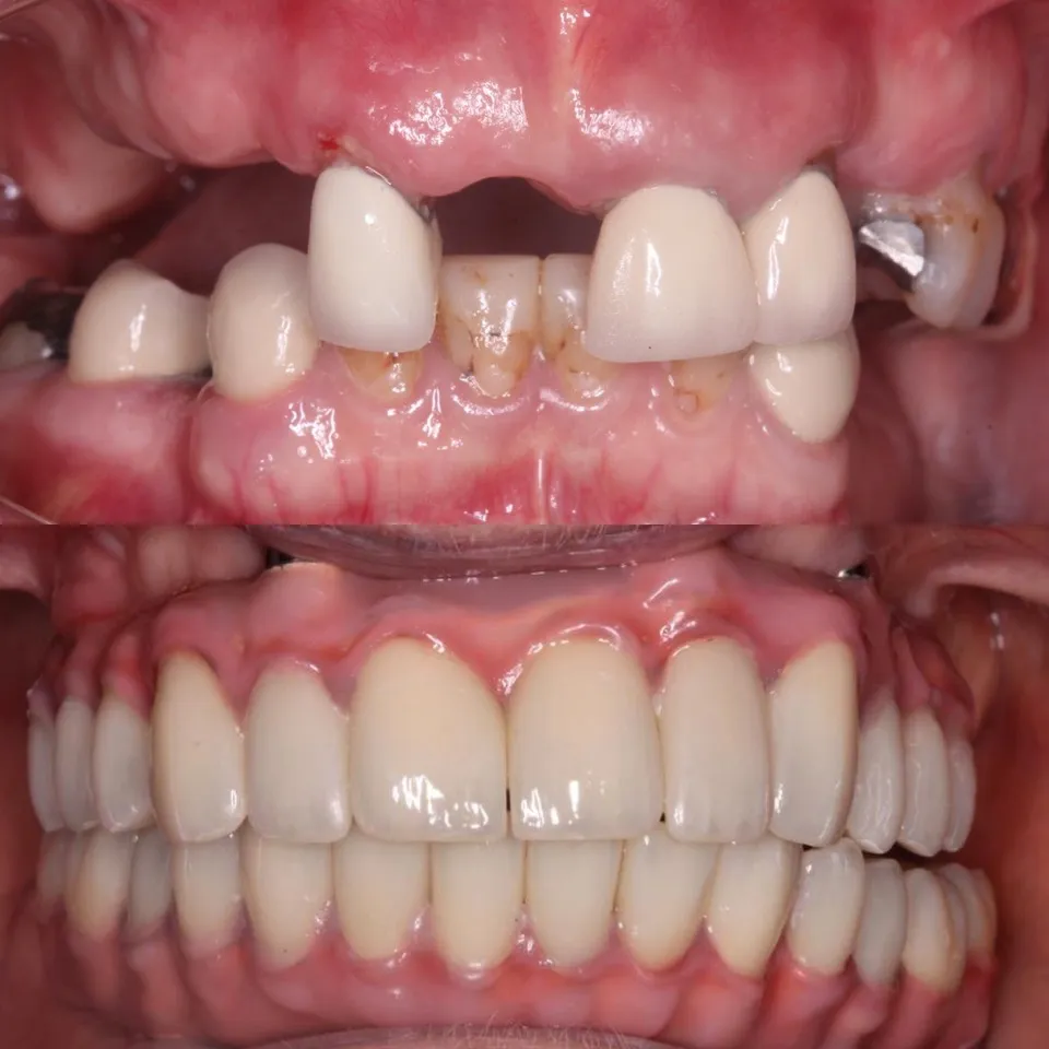 Dental Implant